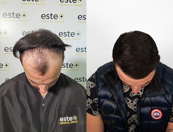 Hair transplant before and after Leeds