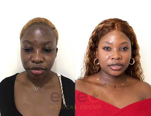Stephanie's pigmentation treatment with Este Medical