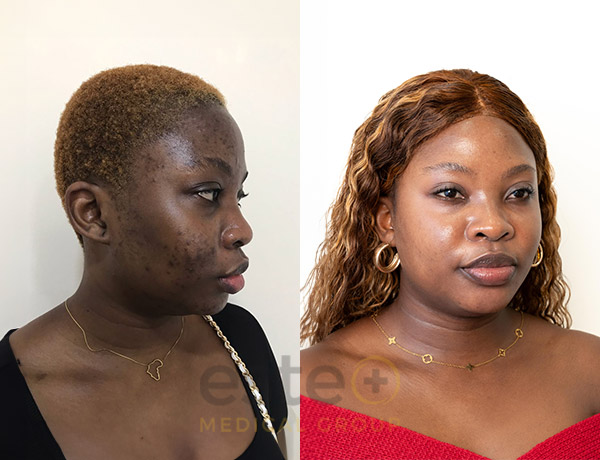 Stephanie's pigmentation treatment with Este Medical