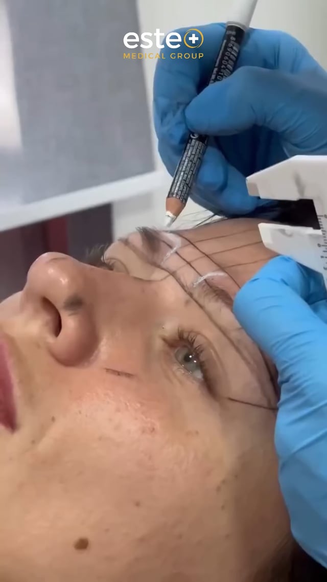 Eyebrow Transplant Results with Este Medical