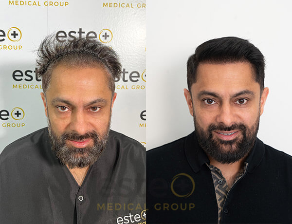 Hair transplant before and after Leeds
