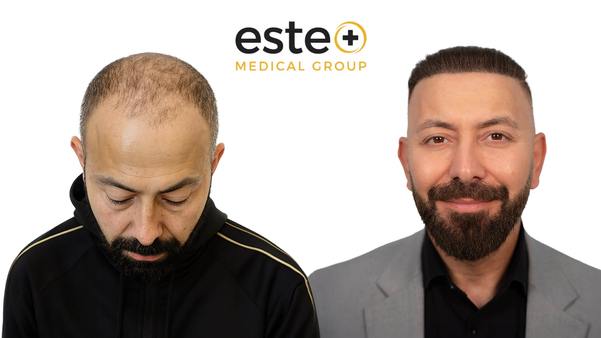 Hair transplant before and after Leeds