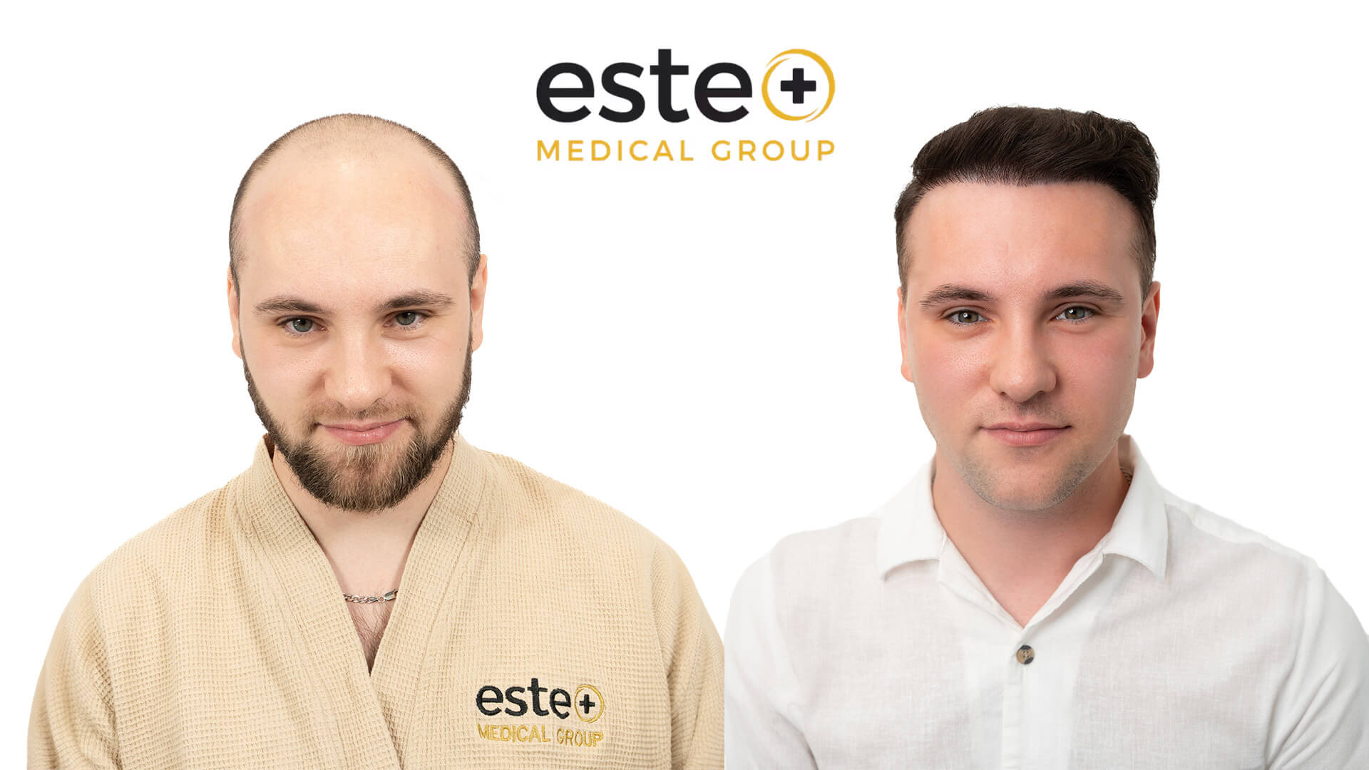 Hair transplant before and after Leeds