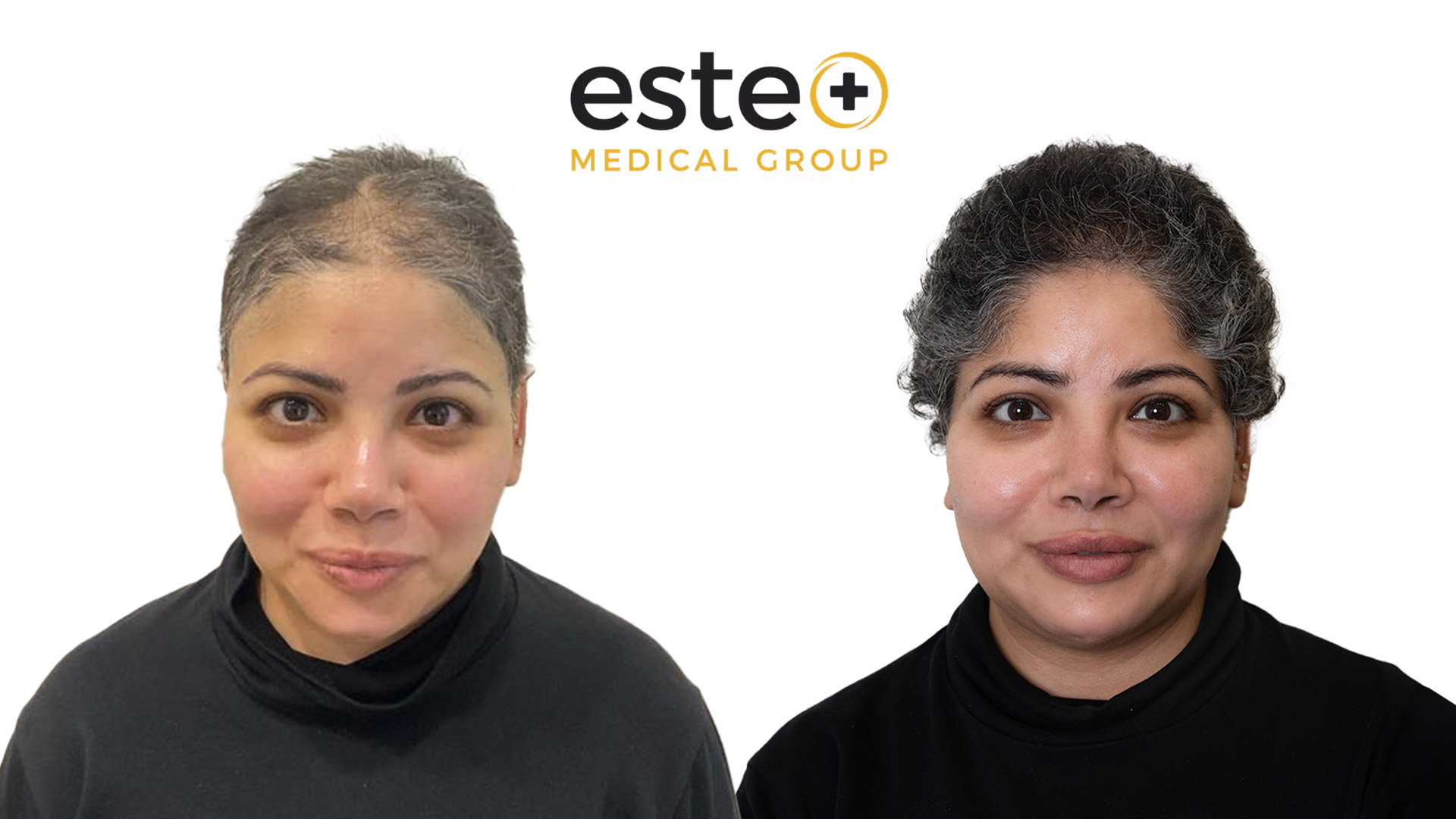 Hair transplant before and after Leeds