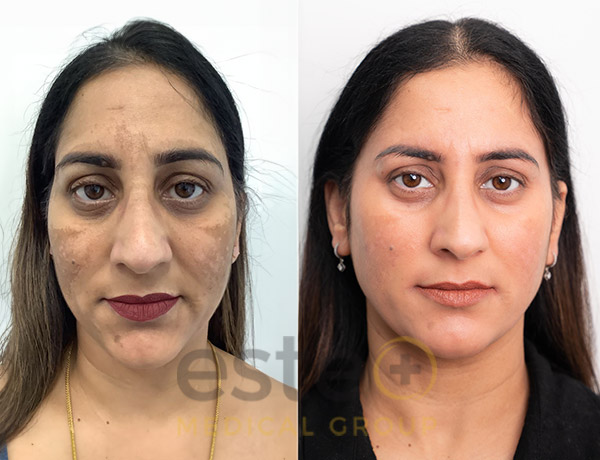 Rajvinder's pigmentation treatment with Este Medical