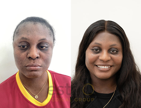 Pigmentation Transformation with Este Medical