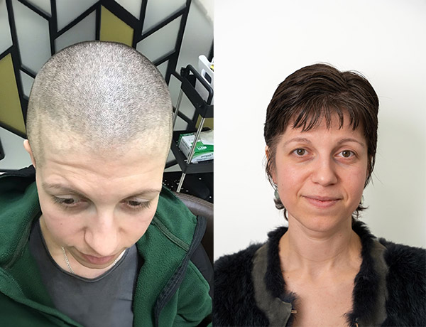 Simona's Alopecia Journey with Este Medical