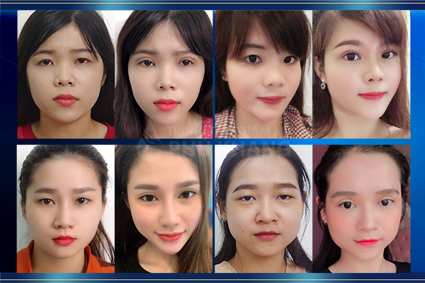 Ưu điểm cắt mắt 2 mí
