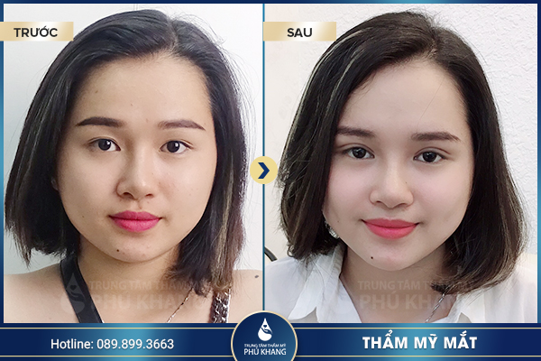 Kết quả cắt mắt ưng ý