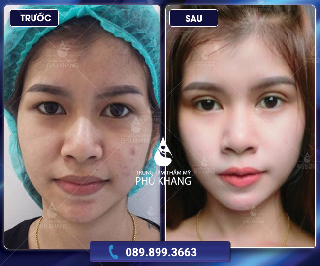 ưu điểm cắt mắt 2 mí tại Phú Khang