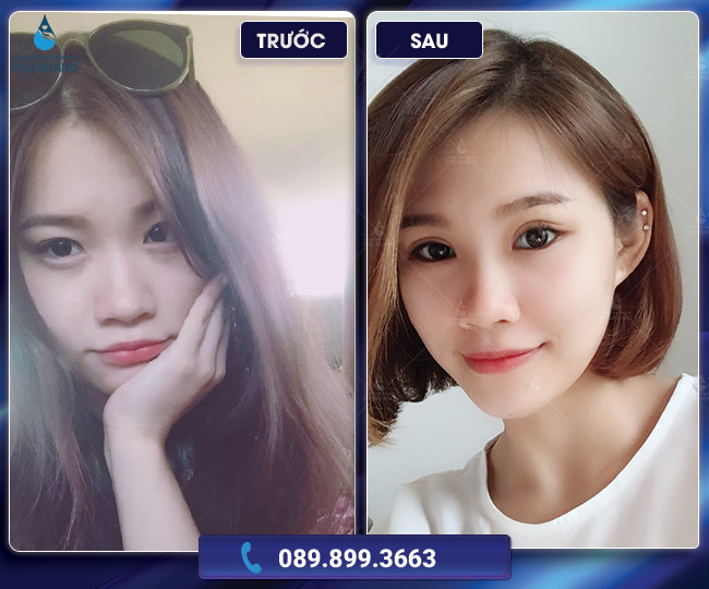 Khách hàng cắt mí tại Phú Khang