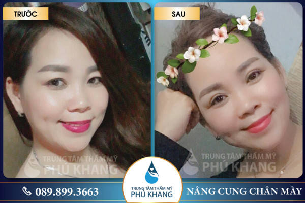 Khách cắt mí mắt tại Phú Khang