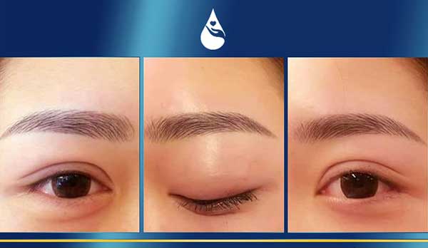 Công nghệ cắt mí plasma