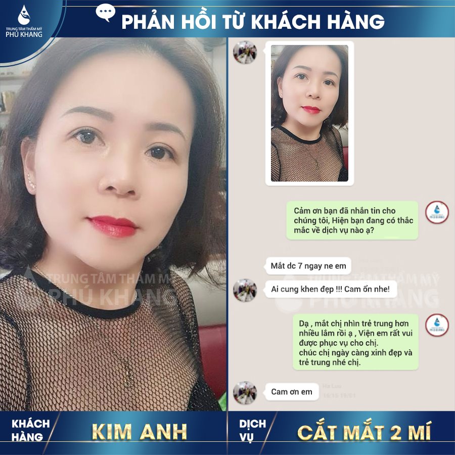 Khách hàng cắt mắt 2 mí tại Phú Khang