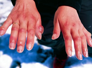 Hands with Frostbite