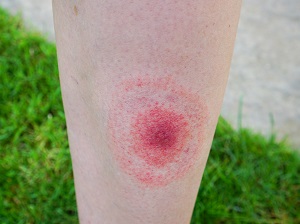 Bulls-eye rash on a person's leg that indicates a likely Lyme Disease infection.