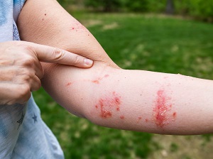 A person holding up their arm showing a terrible poison ivy rash.