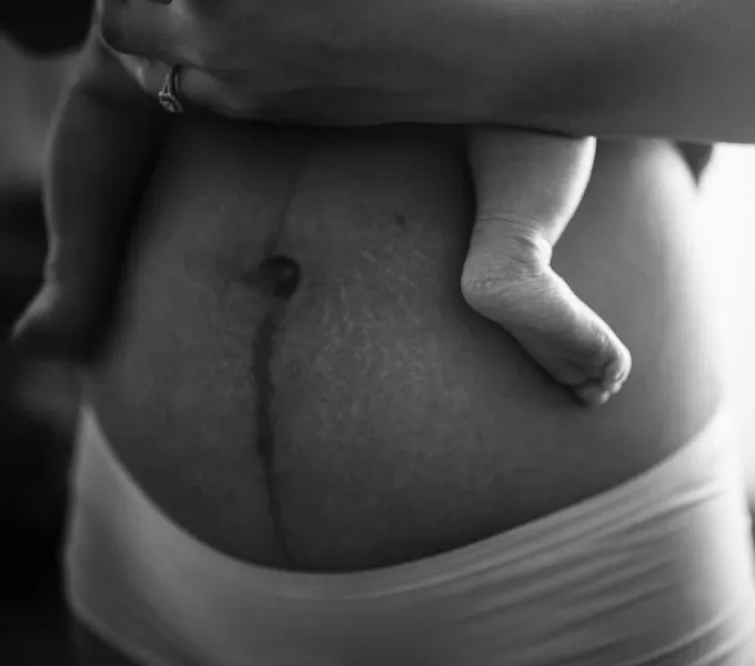 Postpartum belly.