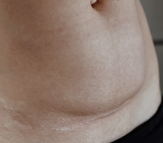 A mom and newborn baby after a c-section delivery.