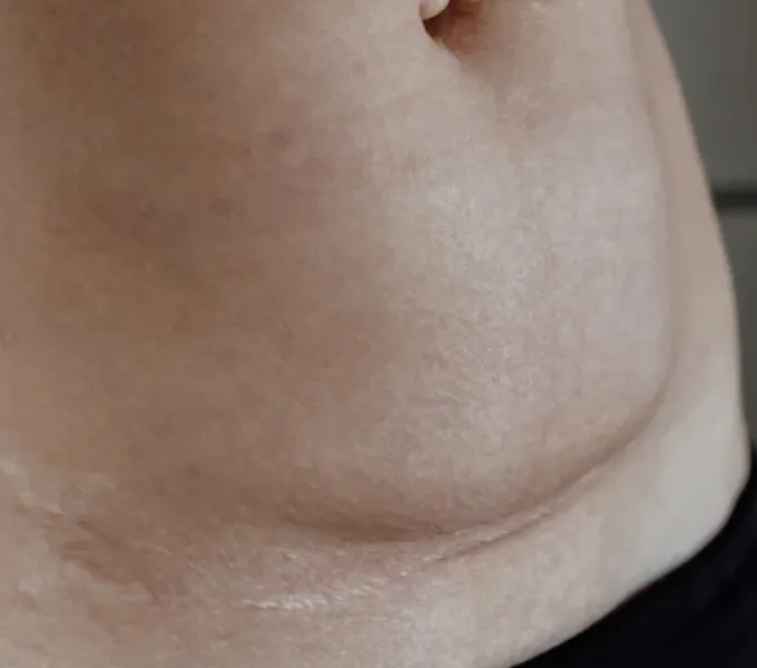 A mom and newborn baby after a c-section delivery.