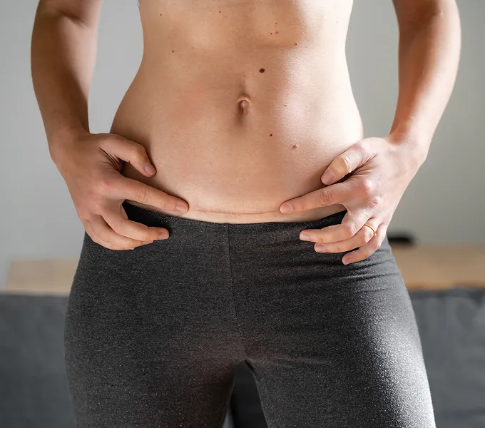 Woman who had a hysterectomy representing hysterectomy prep: what to expect and how to prepare.