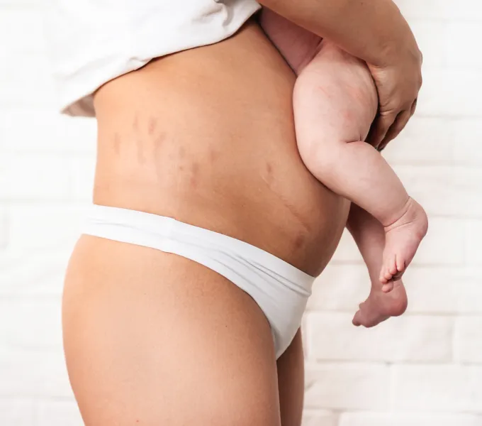 Postpartum mother with levator ani birth injury holding newborn baby.