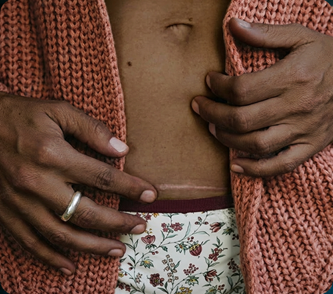 Woman with c-section nerve issues doing pelvic floor physical therapy