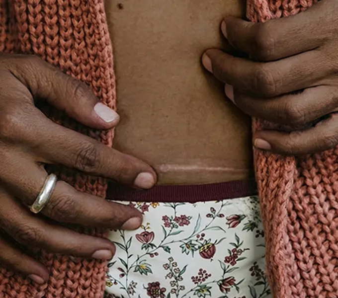 Woman with c-section nerve issues doing pelvic floor physical therapy.