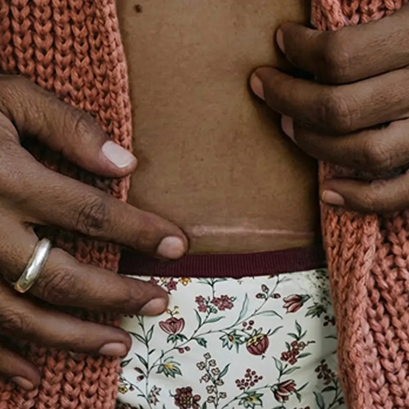 Woman with c-section nerve issues doing pelvic floor physical therapy.
