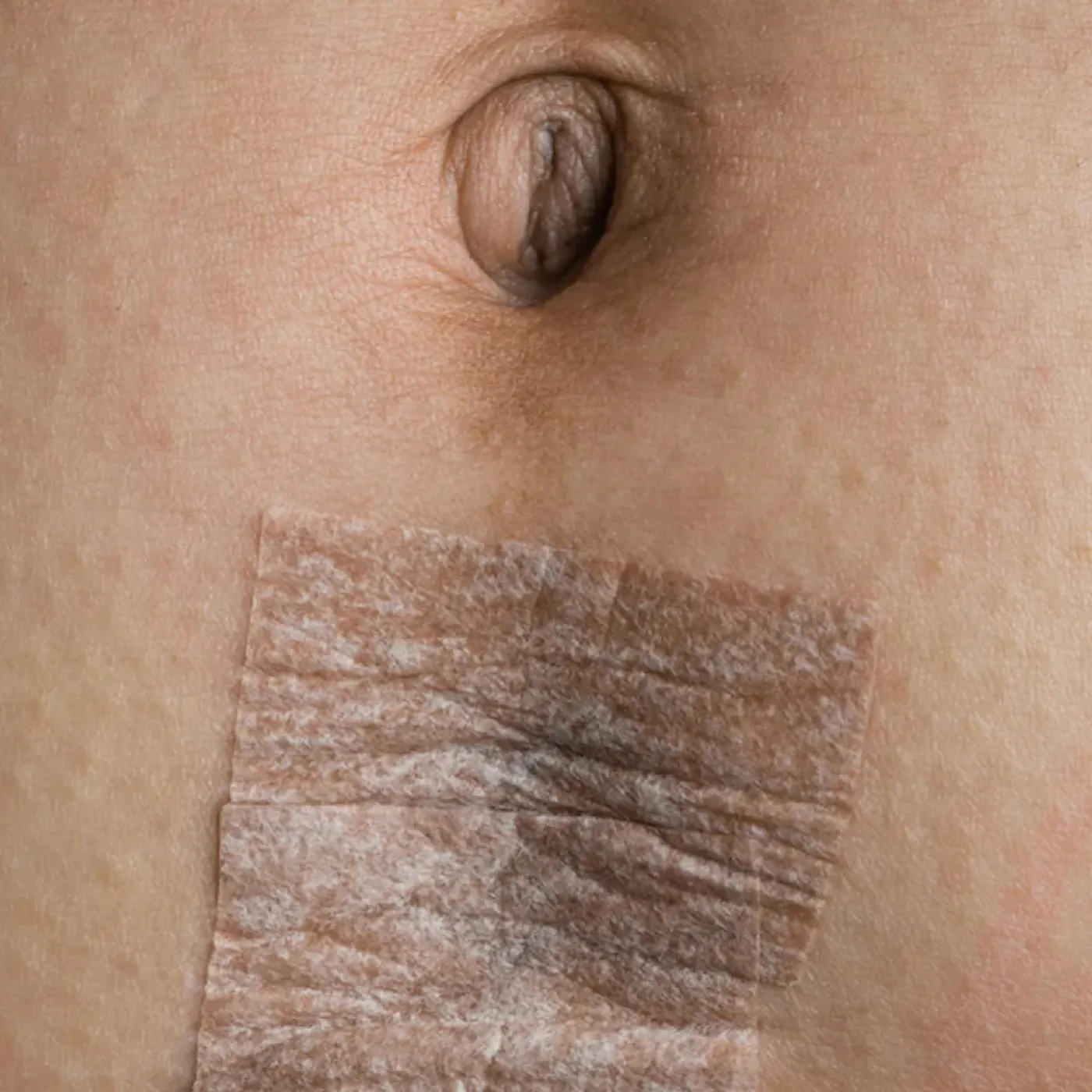 A close up of a c-section incision covered with bandages.