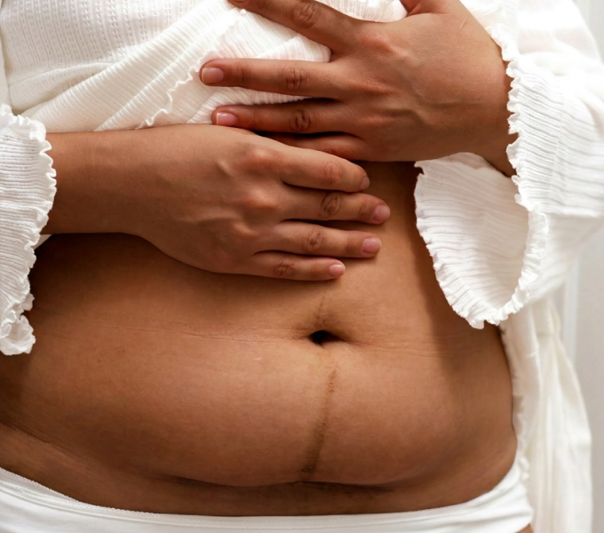 Woman with bladder issues after a c-section