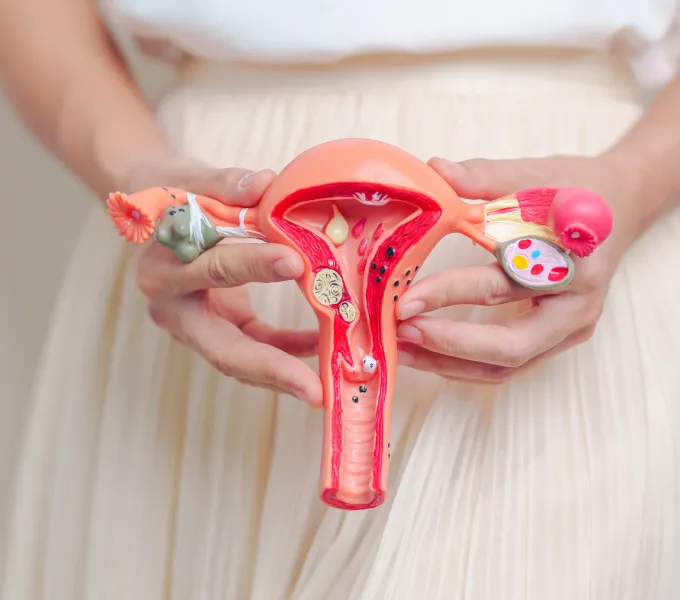 Pelvic model of ovaries represending PMOS, formerly called PCOS.