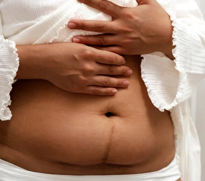 Woman with bladder issues after a c-section.