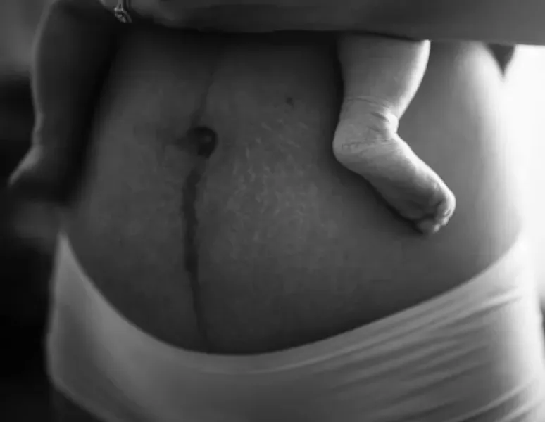 Postpartum belly.