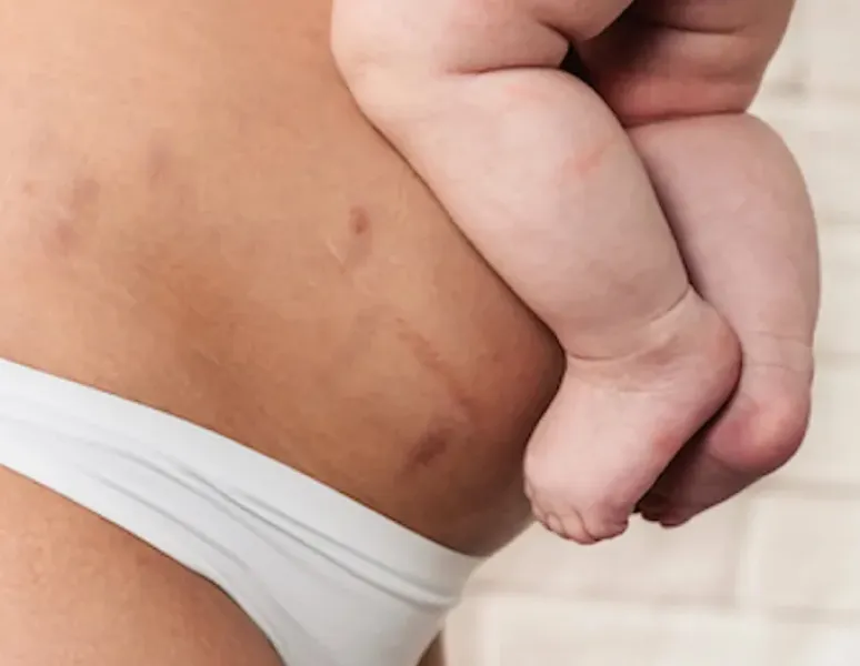 A woman holding her baby close to her postpartum belly above her c-section scar.