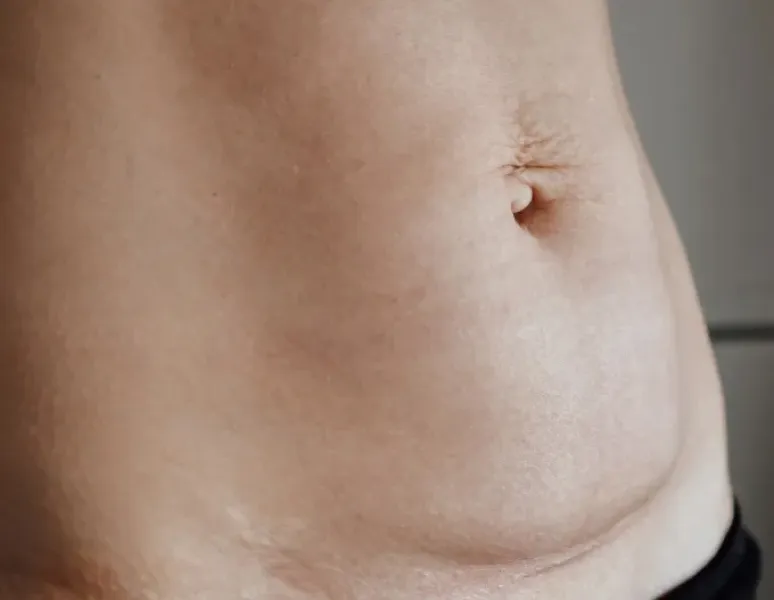 A belly with stretch marks and a cesarean scar massage.