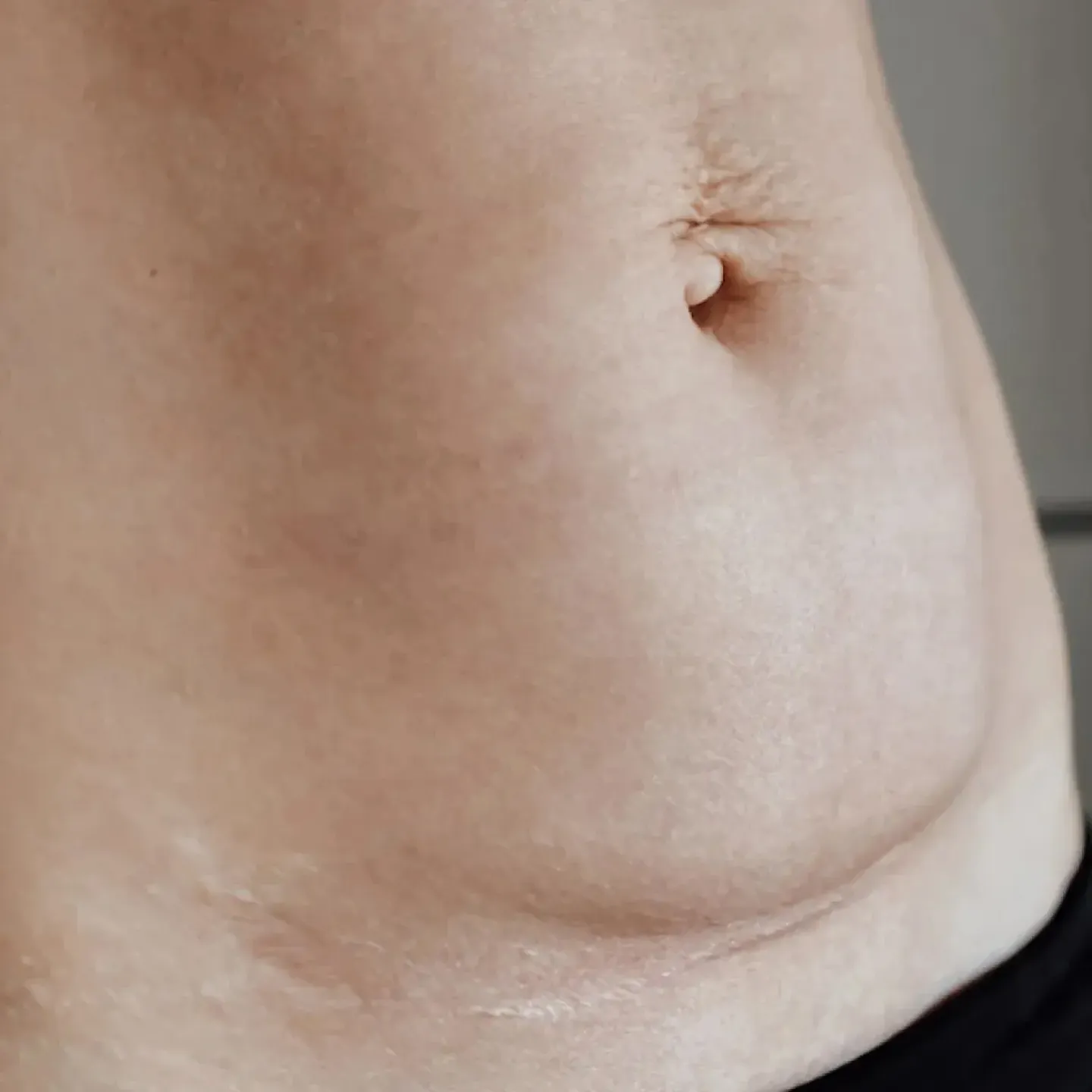 A belly with stretch marks and a cesarean scar massage.