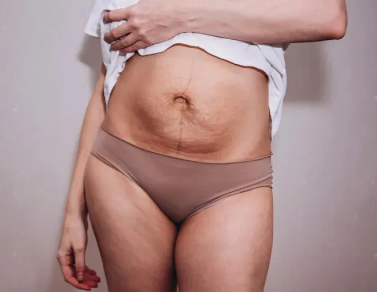A postpartum individual holding up her t-shirt to reveal her belly with stretch marks and a c-section scar that itches and hurts years after childbirth.