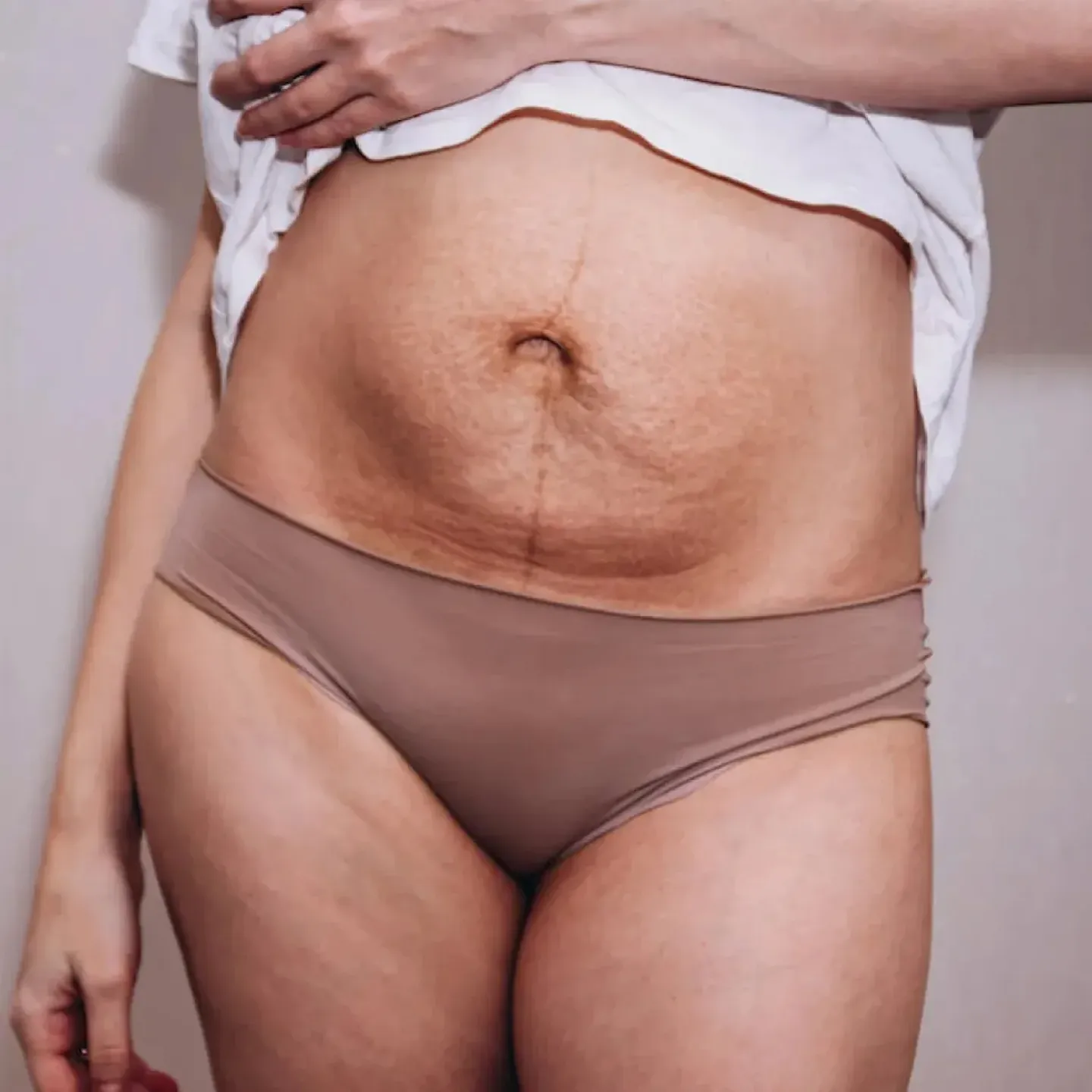 A postpartum individual holding up her t-shirt to reveal her belly with stretch marks and a c-section scar that itches and hurts years after childbirth.