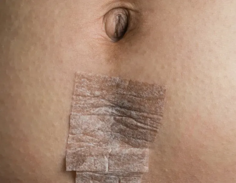 A close up of a c-section incision covered with bandages.