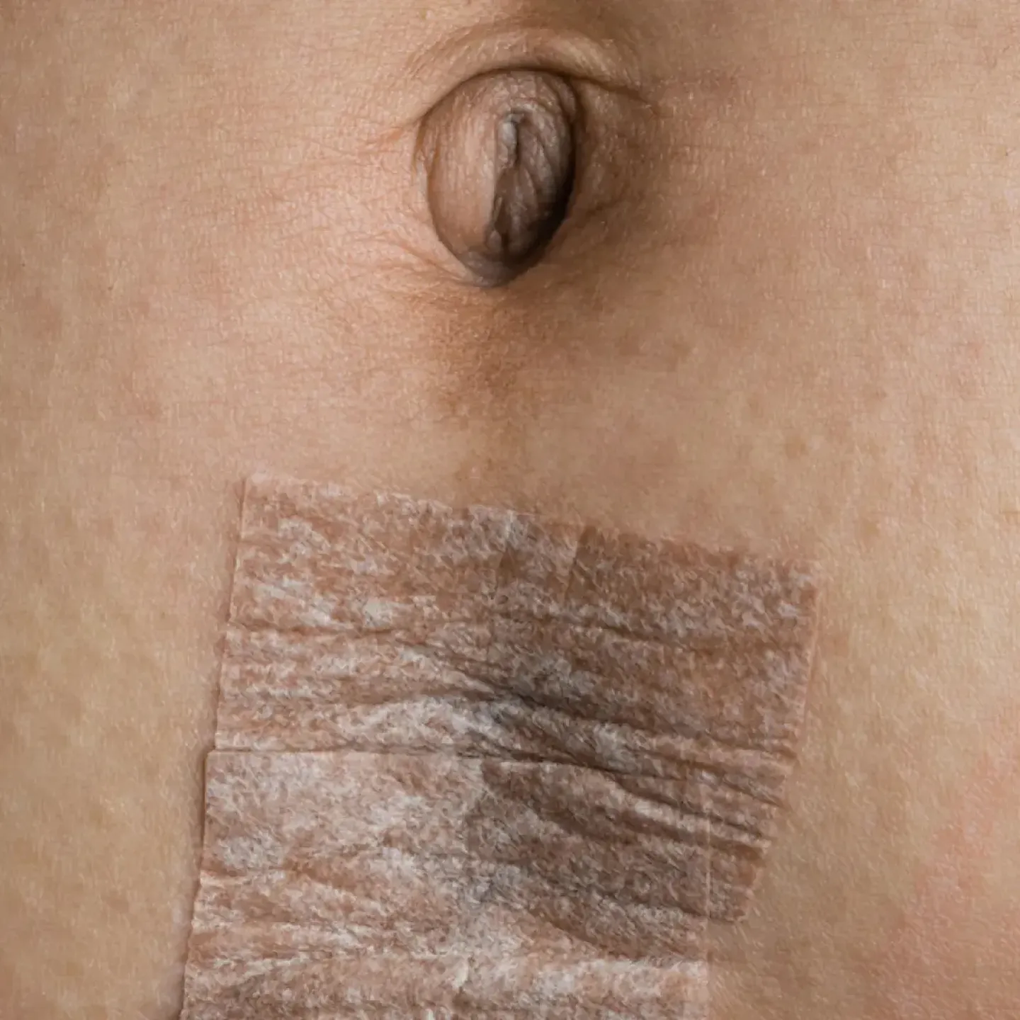 A close up of a c-section incision covered with bandages.