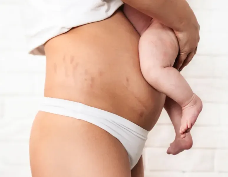 Postpartum mother with levator ani birth injury holding newborn baby.