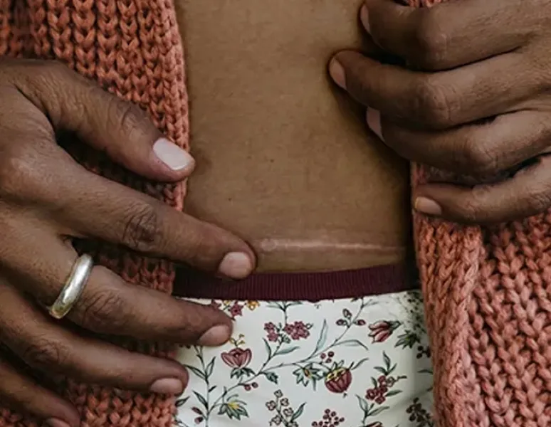 Woman with c-section nerve issues doing pelvic floor physical therapy.