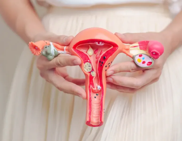 Pelvic model of ovaries represending PMOS, formerly called PCOS.