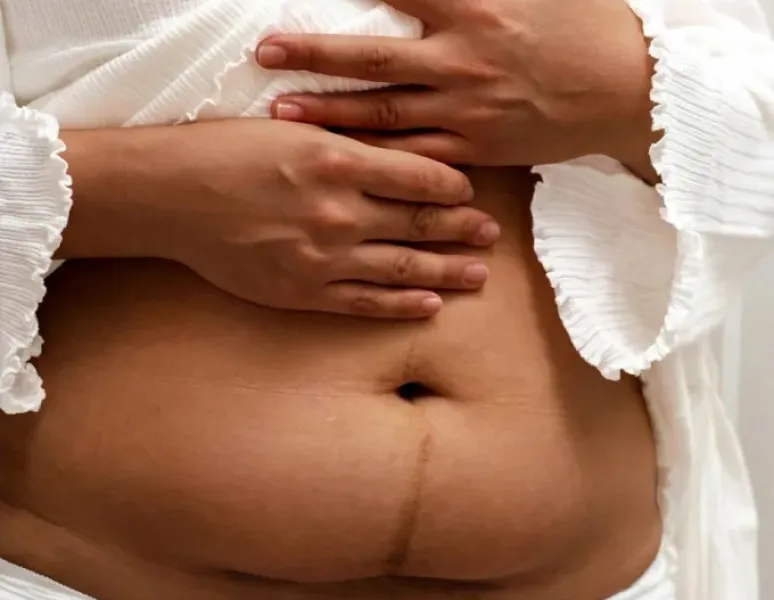 Woman with bladder issues after a c-section.