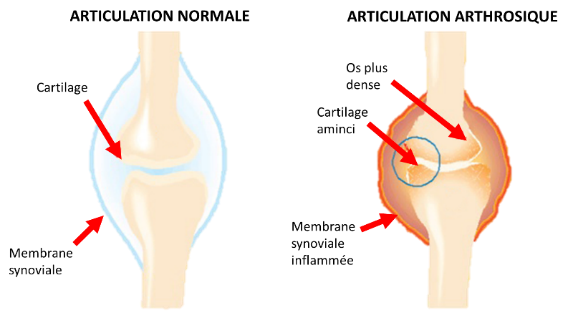 Comparaison articulation avec et sans arthrose