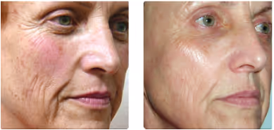 Laser 360 Before and After