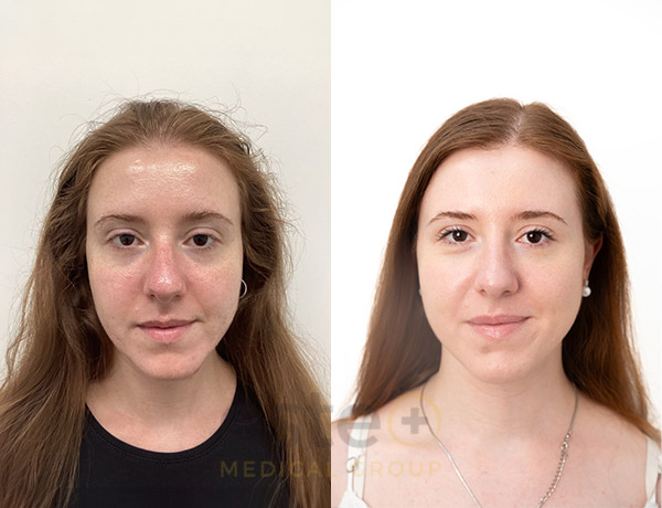 Acne Treatment Result