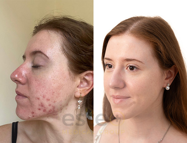 acne treatment before and after