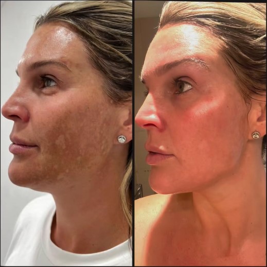 Danielle Lloyd pigmentation results